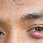 Orgelet et causes émotionnelles : mythe ou lien réel avec le stress
