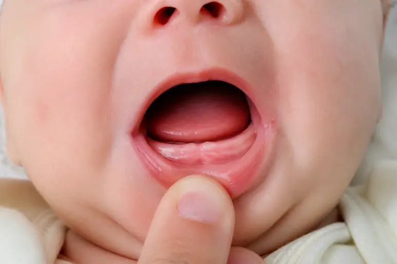 Gencives d'un bébé de 2 mois légèrement gonflées, signe de doublement gencive 2 mois.