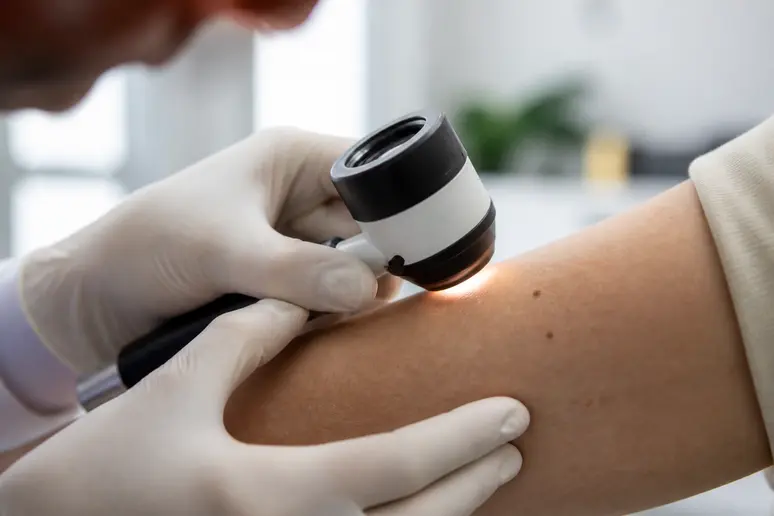 Dermatologue français examinant un grain de beauté suspect à l'aide d'un dermatoscop.